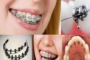 بریس ارتودنسی 