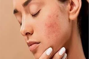 لکه های پوستی