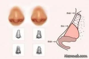 تمایز بینی های گوشتی