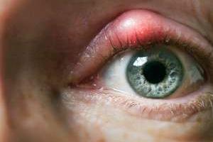 گل مژه در چشم