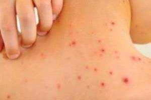 بیماری مورژلونز