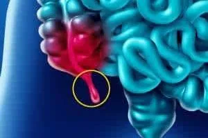 فواید آپاندیس