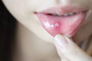 آفت دهان و زبان 
