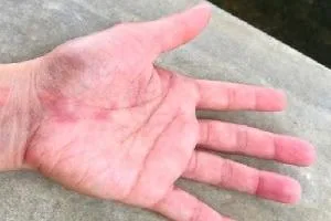 روز جهانی لوپوس