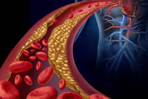 درمان خانگی کلسترول بالا