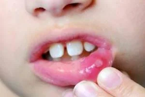 آفت دهان