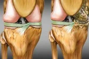 تقویت غضروف زانو