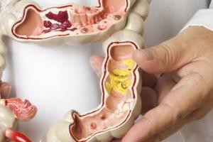 آی بی اس روده