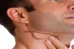 بیماری اوریون