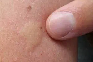 تشخیص نیش حشرات