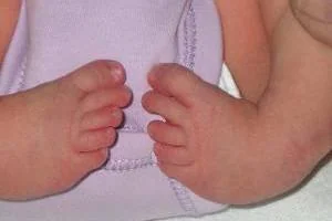 انواع پاچنبری نوزاد