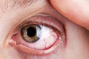 بیماری آر پی