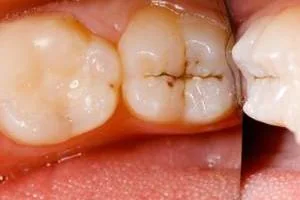 باکتری پوسیدگی دندان