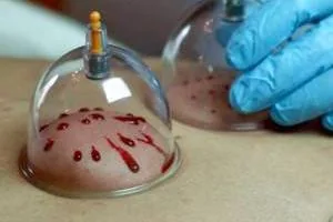 نیاز به حجامت
