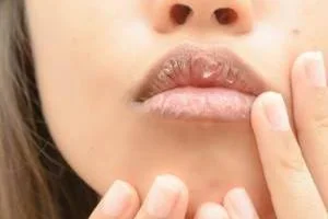 خشکی دور لب