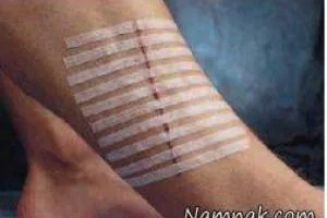 بخیه