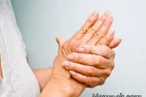 آرتریت روماتوئید