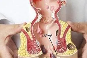 فیستول