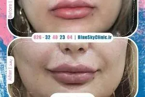 تزریق ژل لب