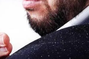 Dandruff