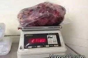 بزرگترین کلیه دنیا
