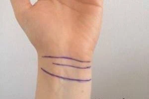فال مچ دست