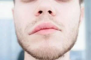تغذیه در فلج بل
