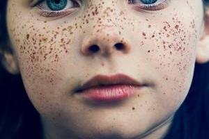 ضایعات پیگمانته
