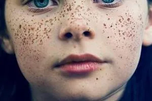 ضایعات پیگمانته