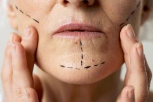 جراحی لیفت صورت