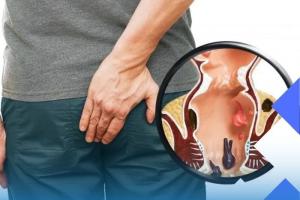 مشکل بواسیر خونی