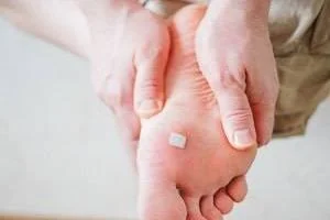میخچه