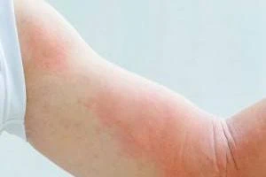 کهیر و آنژیوادم