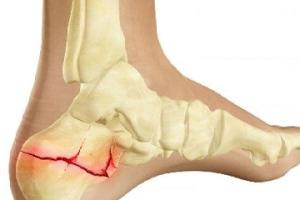 کمک اولیه شکستگی