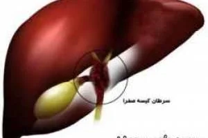 سرطان کیسه صفرا