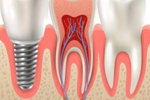 ایمپلنت کاشت دندان