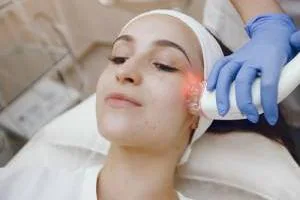 لیزر موهای صورت