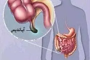 آپاندیس