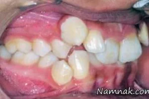 ناهنجاری دندان