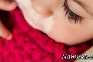 بیماری لک و پیس