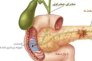 علائم سرطان لوزالمعده 
