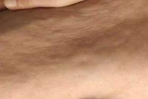 سلولیت 