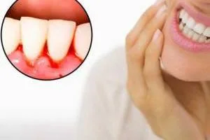 دلیل خونریزی لثه