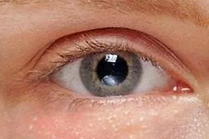 جوش های سفید زیر پوستی یا میلیا