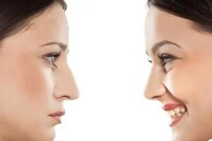 عمل جراحی زیبایی بینی
