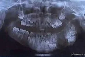 دندان اضافه
