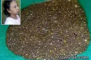 سنگ کیسه صفرا
