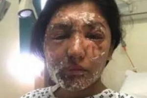 صورت اسید پاشی