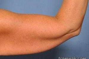 سفت كردن پوست