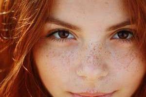 لکه های پوستی